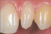 Veneers